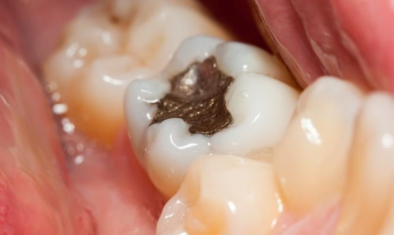 عصب کشی و پر کردن هم‌زمان دندان